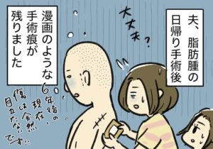 脂肪腫イラスト